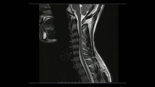 子宫颈脊椎射程T2加权图像MRI脑脊椎的磁共振成像图片