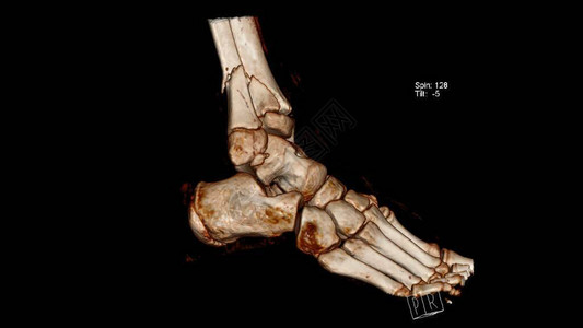 脚踝以上腿骨折蒂比亚和纤维骨的成像图图片