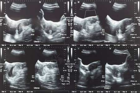 下腹部卵巢和子宫与肿瘤或子宫肌瘤女患者平滑肌瘤的超声图像图片