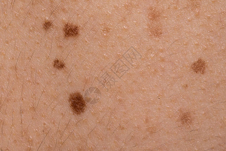 白种人皮肤上良痣的宏观视图白皙皮肤上粉刺美斑和毛囊的详细视图癌症和背景图片