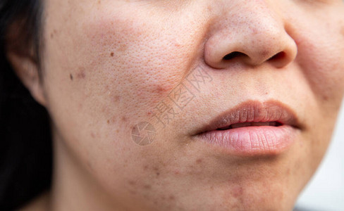 妇女中年种族出身的Asia人脸部皮肤有问题图片