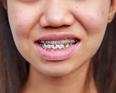 有牙齿的亚洲青少年种族问题可以用牙套处理图片