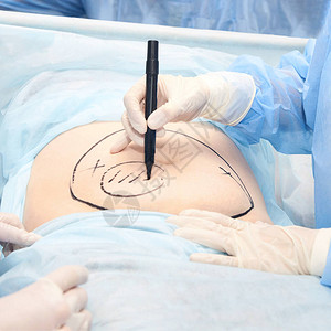 手术室腹部手术医生在腹部标记吸脂区域在皮肤上绘图抗脂肪团设备复制空间浅蓝色腹部肥胖Hostip图片