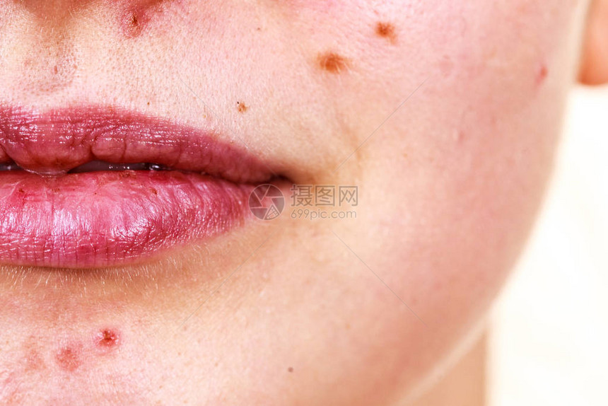 年轻女用醋和子干嘴唇露面少女在下巴上没有红斑点的补偿健康问图片