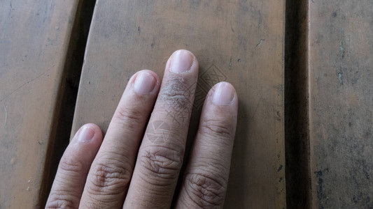 寻常型银屑病真菌女手指上的湿疹背景图片