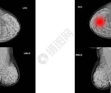 两边都收集乳房X射线成像以提图片