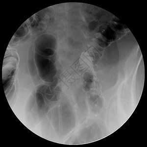 大肠或结肠的钡灌肠图像或X射线图像显示大肠和阑尾的解剖结构图片