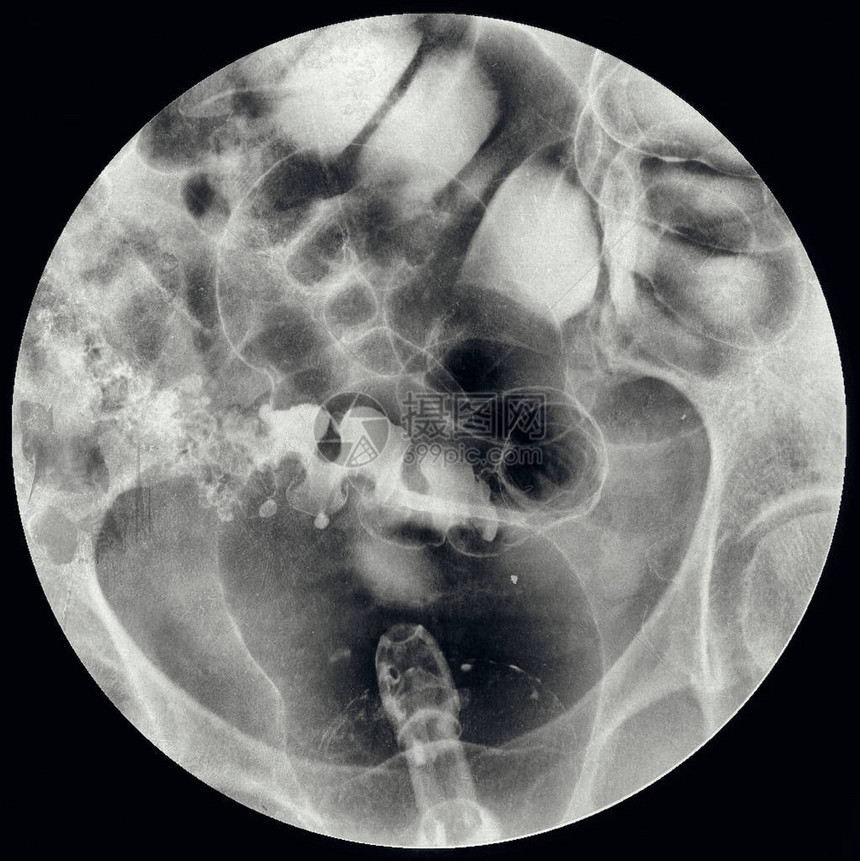 钡灌肠双重对比研究结肠直X射线图片