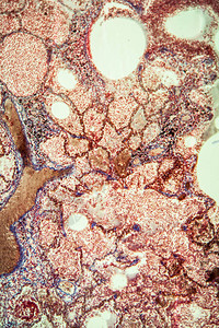 显微镜下的肺结核组图片