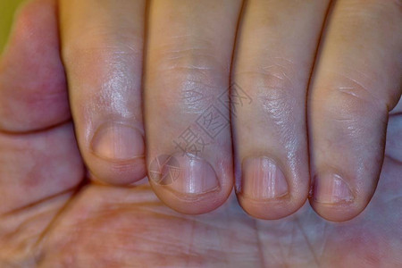 咬指甲对很多人来说是个坏习惯图片