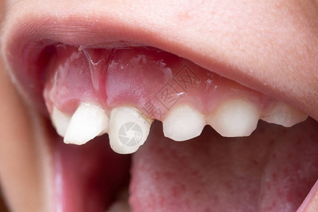 孩子嘴里的牙齿歪了高清图片