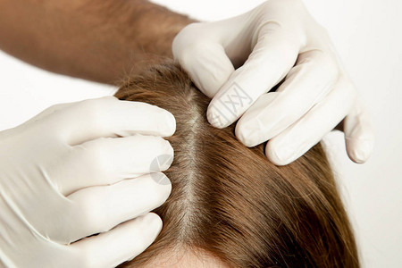 医生检查女头发皮头皮湿疹皮炎牛皮癣脱发头皮屑或图片