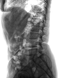 患者的诊断脊柱X射线胶片图片