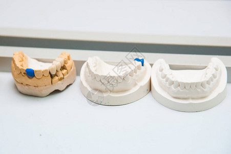 牙医用石膏做成牙齿植入假肢图片