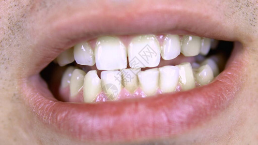 年轻人的牙齿有弯曲的牙图片