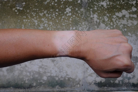 左手腕表的伤痕皮肤图片