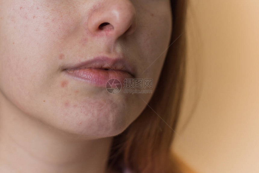 Acne和疤痕图片