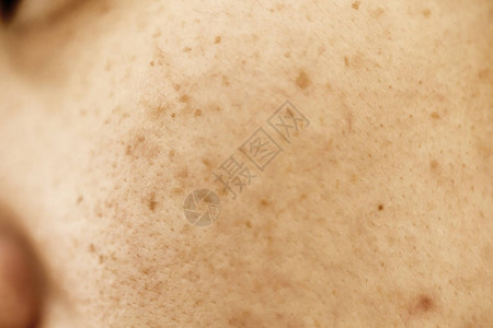 女人的问题皮肤痤疮疤痕油皮肤和毛孔黑斑和脸上图片