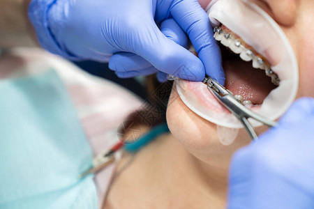 正畸牙医在办公室执行为患者口腔中的牙套提背景图片