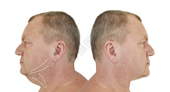 男双下巴治疗前后背景图片