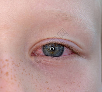 一个有结节炎的青少年的眼图片