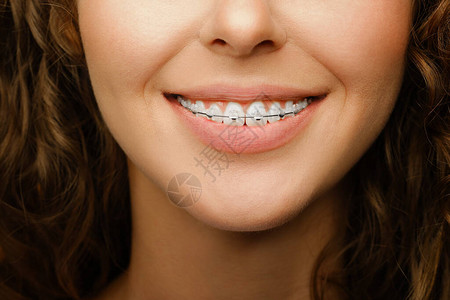 穿着牙套和整牙治疗的白牙女美人笑脸近身镜头图片