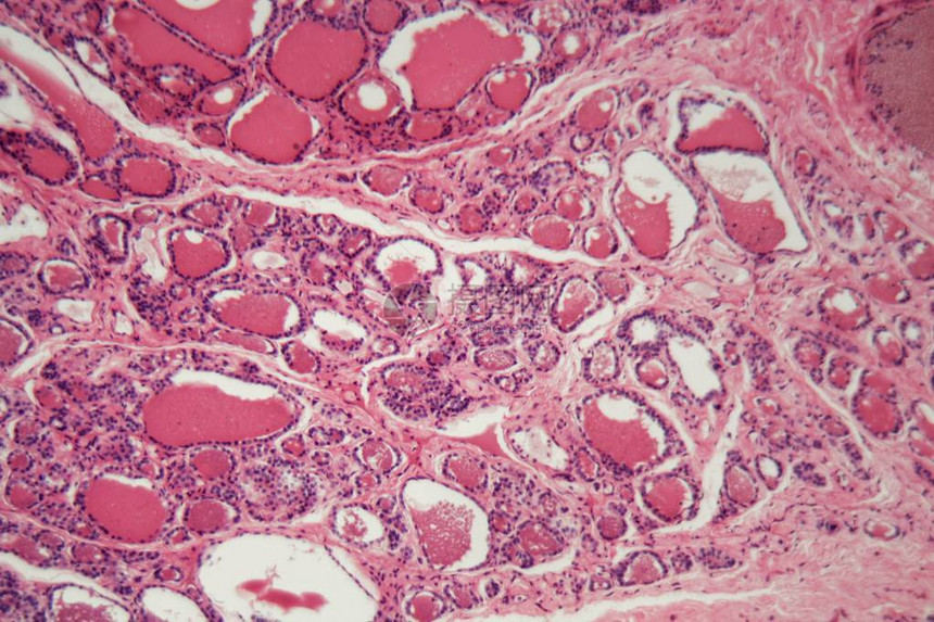 显微镜下的人类甲状腺细胞肿图片