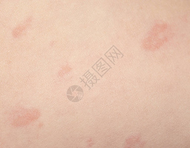 皮肤病荨麻疹皮肤红斑和瘙痒图片