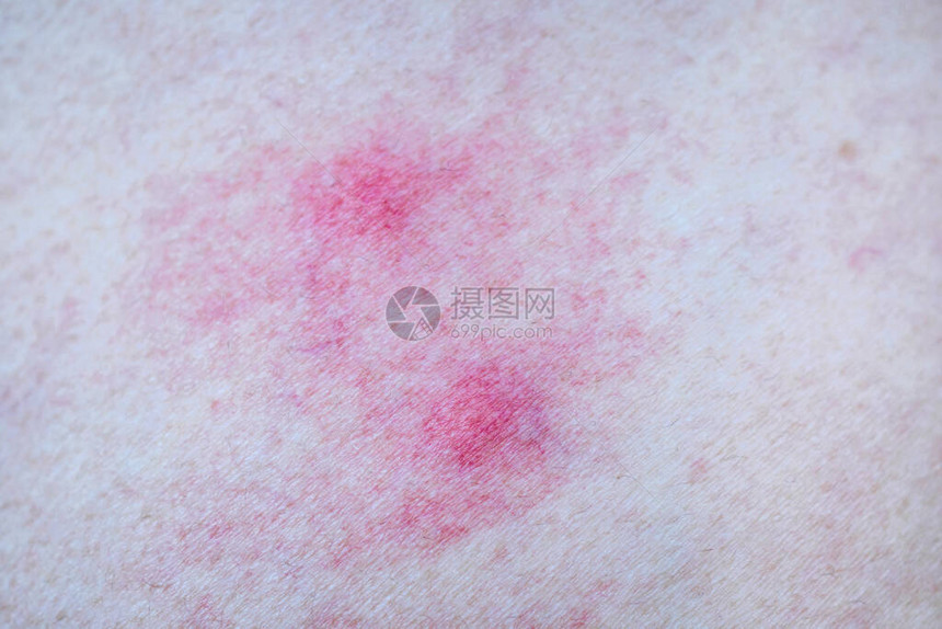 蚊虫叮咬引起的皮肤过敏图片