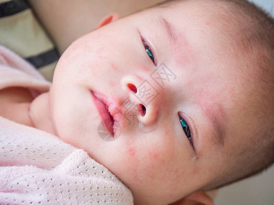 新生婴儿脸上有皮炎过敏图片