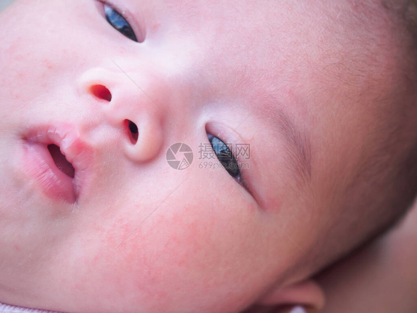 新生婴儿脸上有皮炎过敏图片