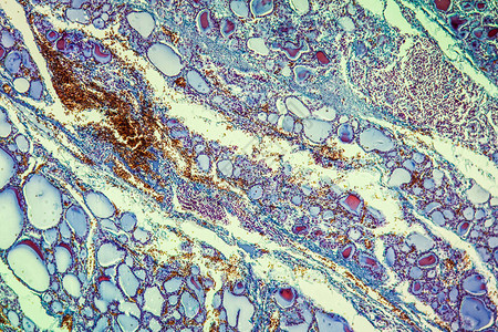 甲状腺肿伴胶体甲状腺疾背景图片
