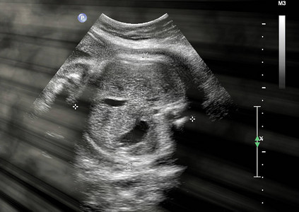 怀孕第三个月的胎儿超声怀孕第三个背景图片