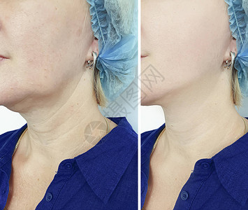 双下巴吸脂女人在治疗前后皱纹脸双下巴背景