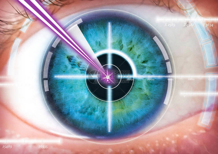 眼部激光手术屈光度眼部图片