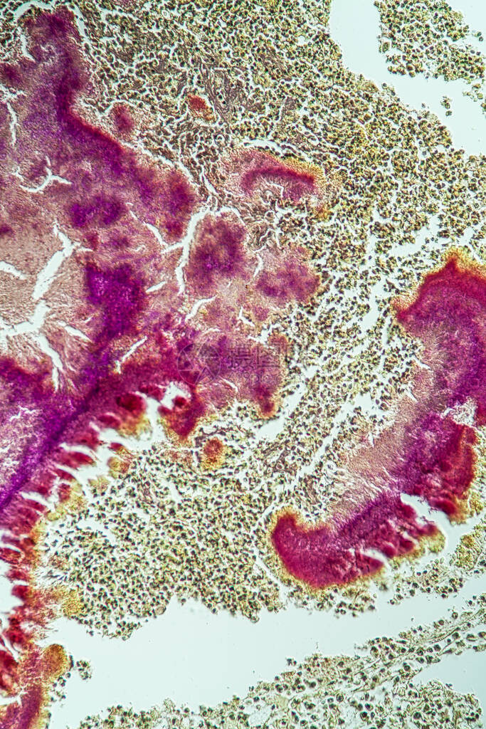显微镜下活肿瘤疾图片