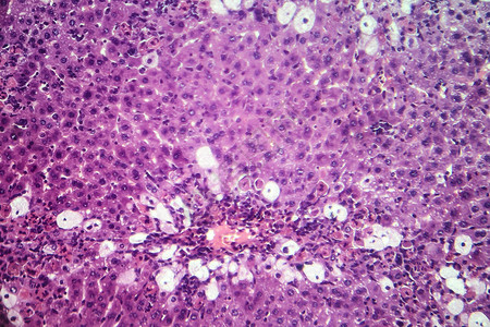 肝炎轻显微镜显图片
