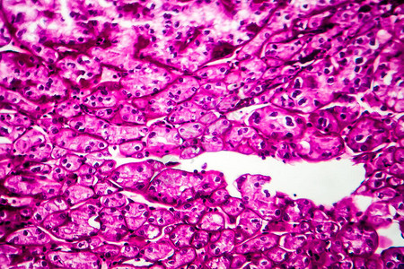 肾癌轻显微镜显背景图片