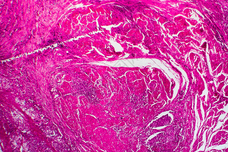 刀型癌症轻显微镜显图片