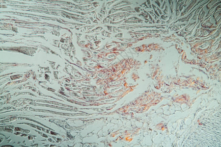 200x显微镜下有氨基质组织病图片