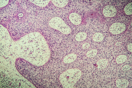 显微镜下的鲍文疾病肿图片