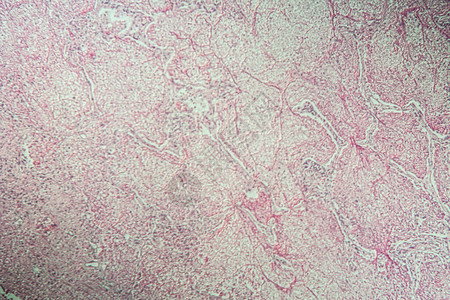 显微镜下的发炎组图片