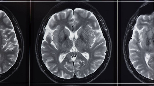 放射室正常脑T2加权磁共振照片图片
