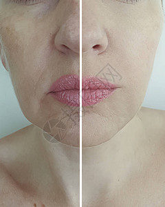 面部女皱纹治疗前后图片