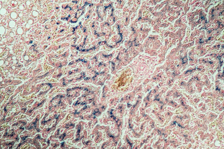 显微镜下的含铁血黄素沉着症肝脏200x背景图片