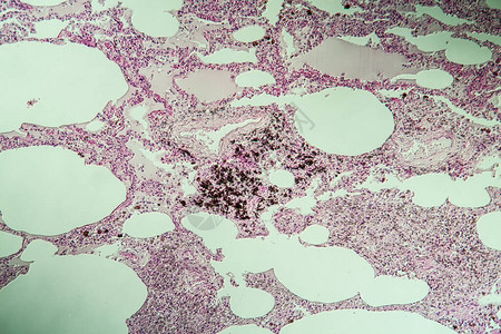 肺组织作为显微镜下的粉尘高清图片
