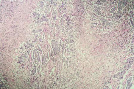 100x显微镜下的胃癌组织背景图片