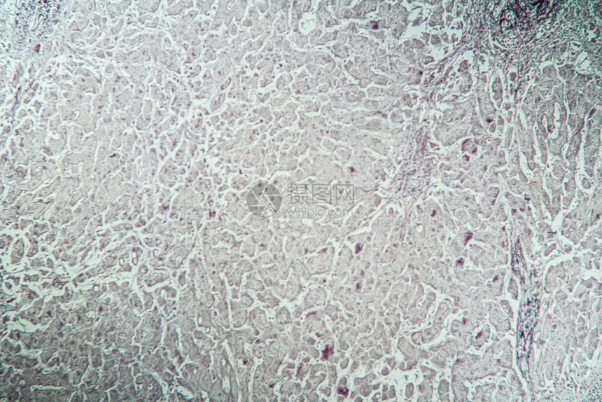 显微镜下病组织肝炎图片