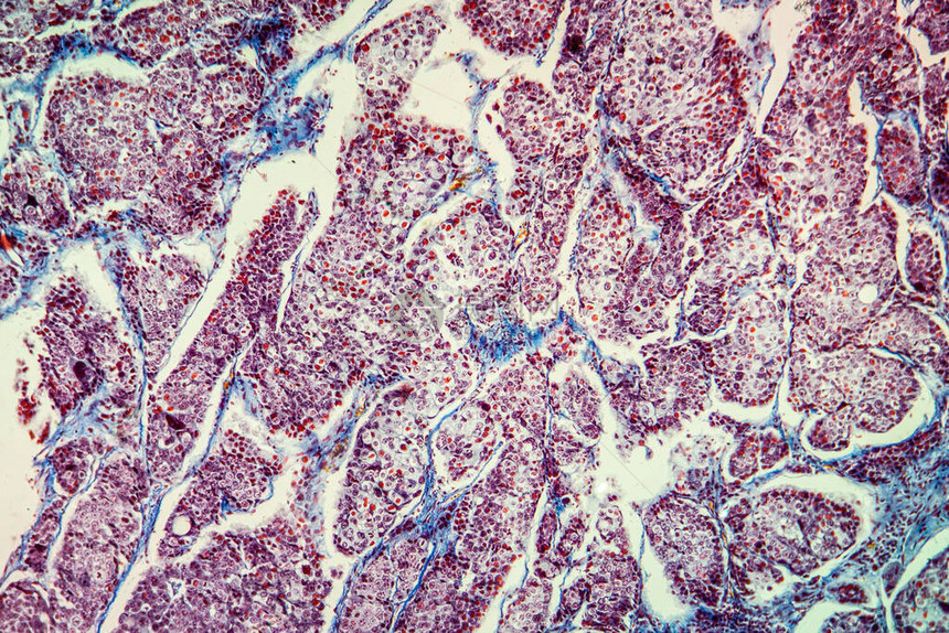 Basal细胞癌疾病组图片