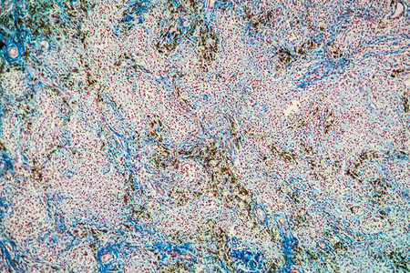 显微镜下外体颗粒瘤组高清图片